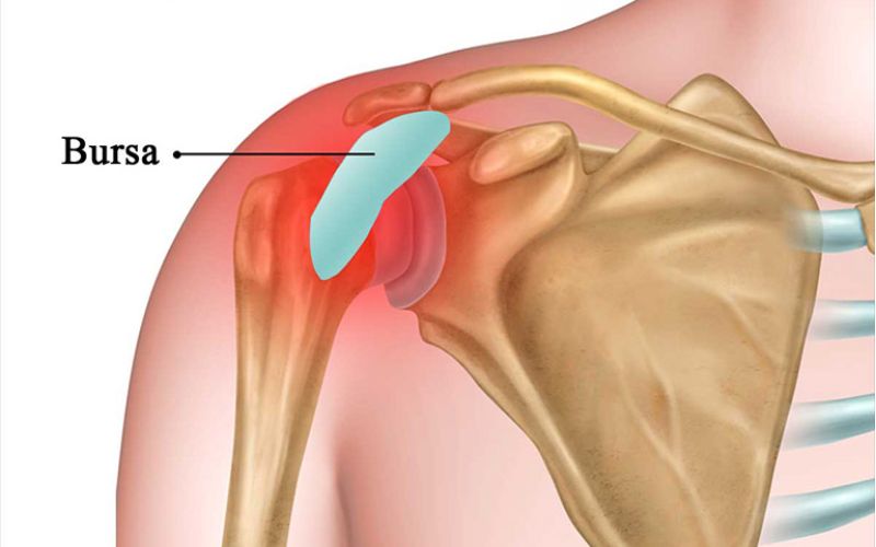 Viêm bao dịch khớp vai trái