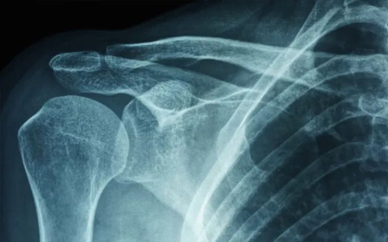 Viêm dính khớp vai