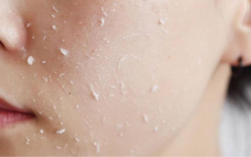 Tẩy tế bào chết nhiều